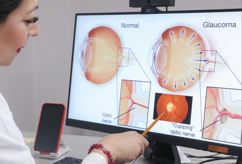 prevención y tratamiento del glaucoma